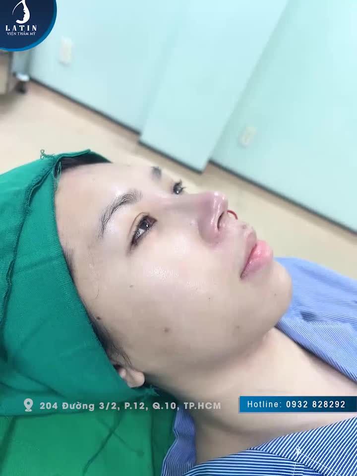 Chỉ hơn 1 tiếng là có mũi đẹp, có bạn nào muốn không ạ